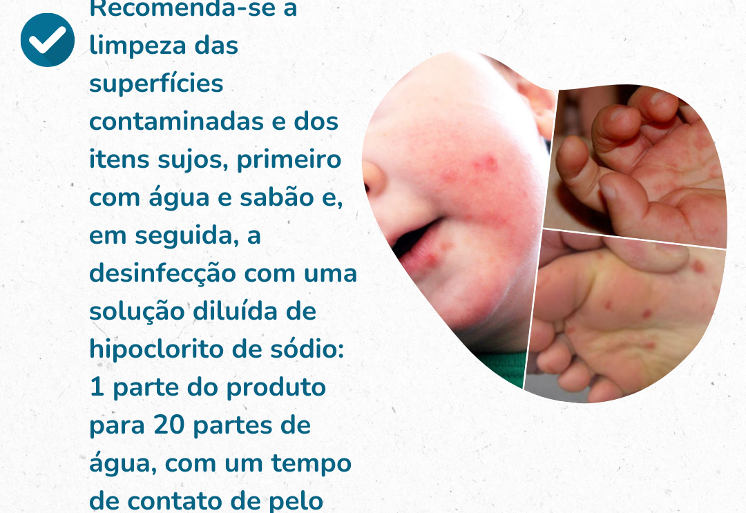 Secretaria de Saúde alerta para surto de mão, pé e boca